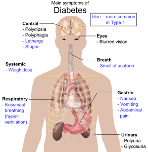 Type 1 Diabetes