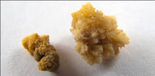 Kidney stones