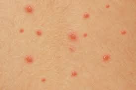 Chicken pox infection and treatment
