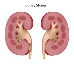 download - Kidney Stones - Symptoms, Diagnosis, Types, Treatment and Risk Factors