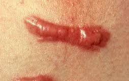 Keloid- an outgrowth of scar repairing tissue