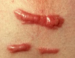 Keloid- an outgrowth of scar repairing tissue