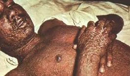 Small pox –symptoms and treatment