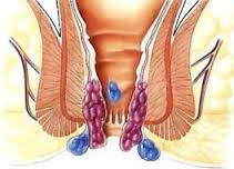 Haemorrhoids or commonly called as Piles