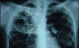 Tuberculosis (TB)-Lung disease