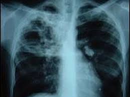 Tuberculosis (TB)-Lung disease
