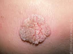 Wart- An epidermal benign tumor caused by virus