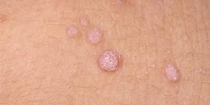 Wart- An epidermal benign tumor caused by virus