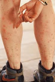 images1 - Symptoms treatment and Causes Of Dengue fever