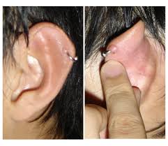 Keloid- an outgrowth of scar repairing tissue 