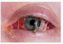 Conjunctivitis commonly called as madras eye or pink eye