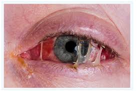 Conjunctivitis commonly called as madras eye or pink eye