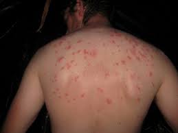 images3 - Signs and symptoms of Typhoid Fever
