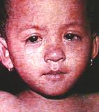 images8 - Measles also known as Rubeola