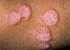 patches - Hansen's disease commonly called as leprosy