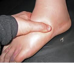 Edema- Accumulation of fluid in tissues