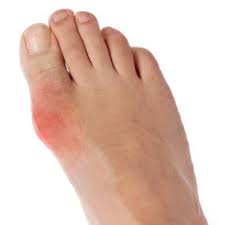 Gout- A form of arthritis
