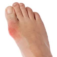 Gout- A form of arthritis