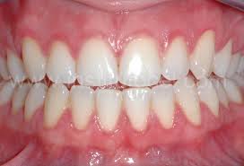 Gingivitis- a common dental disease