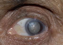 Cataract- An eye disorder