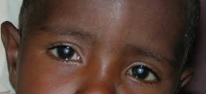 Congenital Cataract