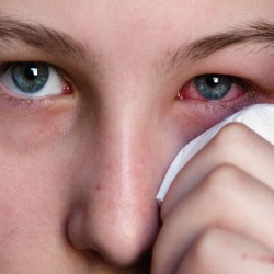 Why do Dry eye cases peal in April ?