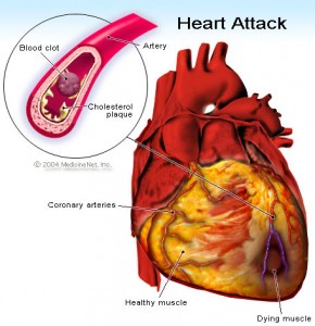 Early Warning Signs Of Stroke Heart attacks