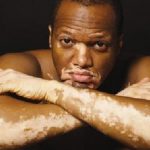 Home remedies for vitiligo