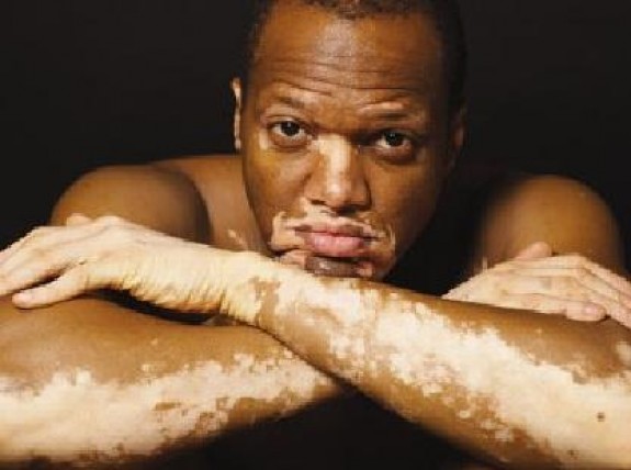 Home remedies for vitiligo