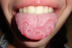 Causes Of Sore Tongue