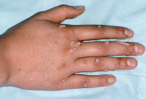 home remedies to treat warts