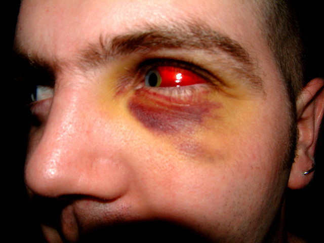 Remedies And Causes of red eyes