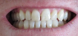 4882792196 9b4b407ebe o 300x141 - Foods That Cause Yellow Teeth