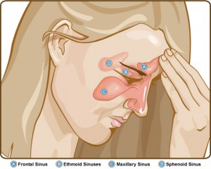 Natural remedy to treat sinusitis