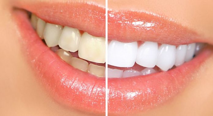 How to Get White Teeth Naturally?