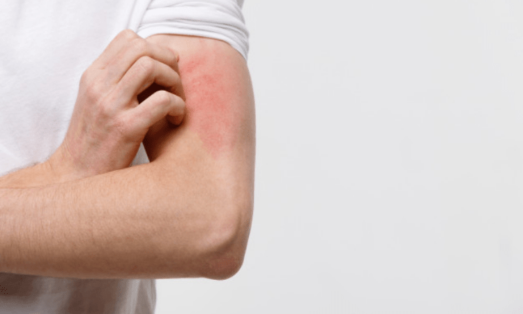 Carbuncle – A bacterial infection of skin