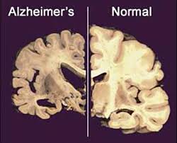 Alzheimer disease – a neurodegenerative disease
