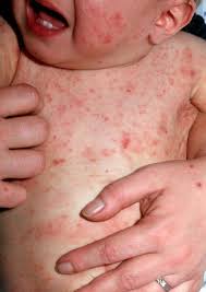 Scabies- a contagious skin infection