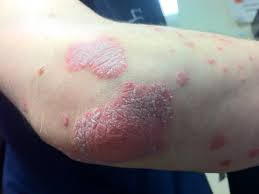 Psoriasis is a skin problem