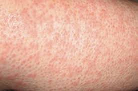 Scabies- a contagious skin infection