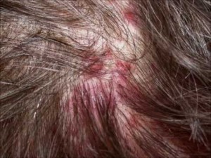 hqdefault 300x225 - How To Prevent Pimples On Head