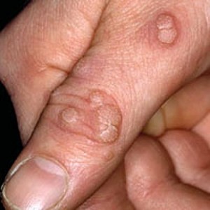 Painless ways to remove warts