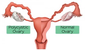 Polycystic Ovary Syndrome