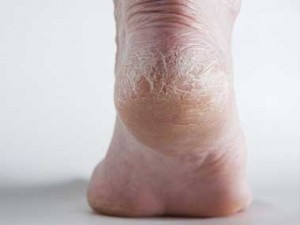 5 symptoms Of Diseases Revealed By Feet