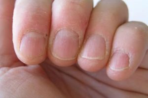 Treat Painful Peeling Cuticles Around Nails Naturally
