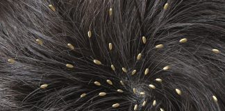 Home remedies for hair lice