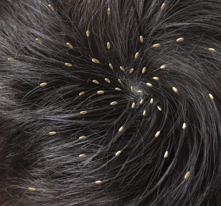Home Remedies for Hair Lice