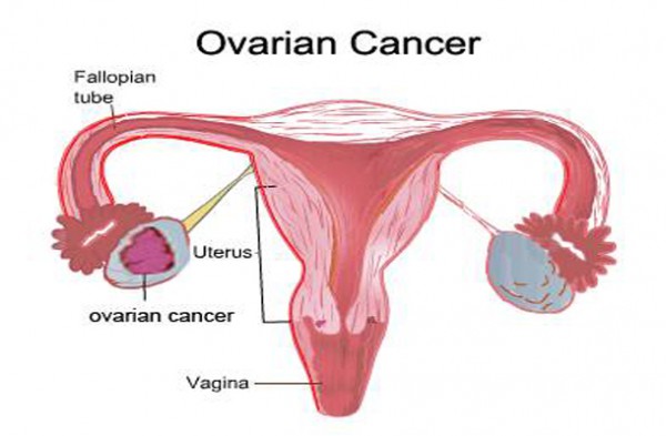 Top 10 warning signs of ovarian cancer