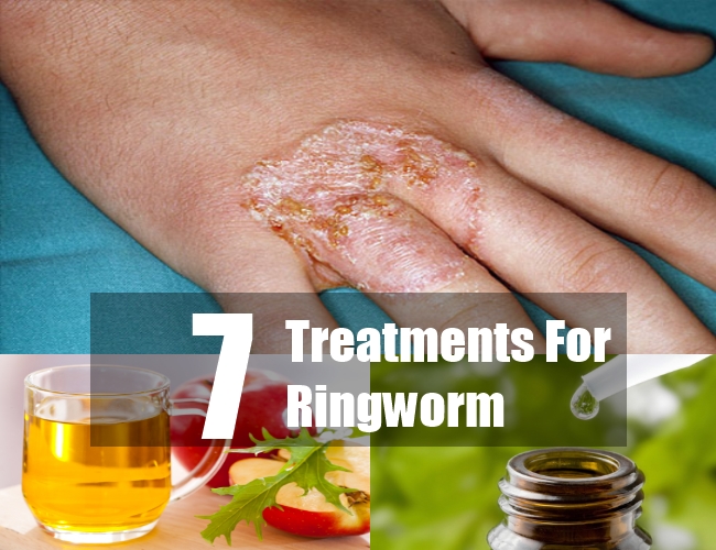 Herbal Remedies To Treat Ringworm