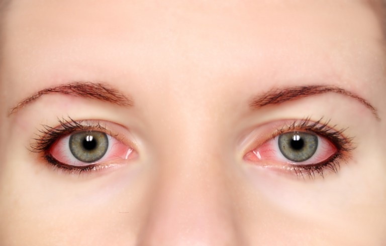 Best 5 natural ways to soothe tired eyes